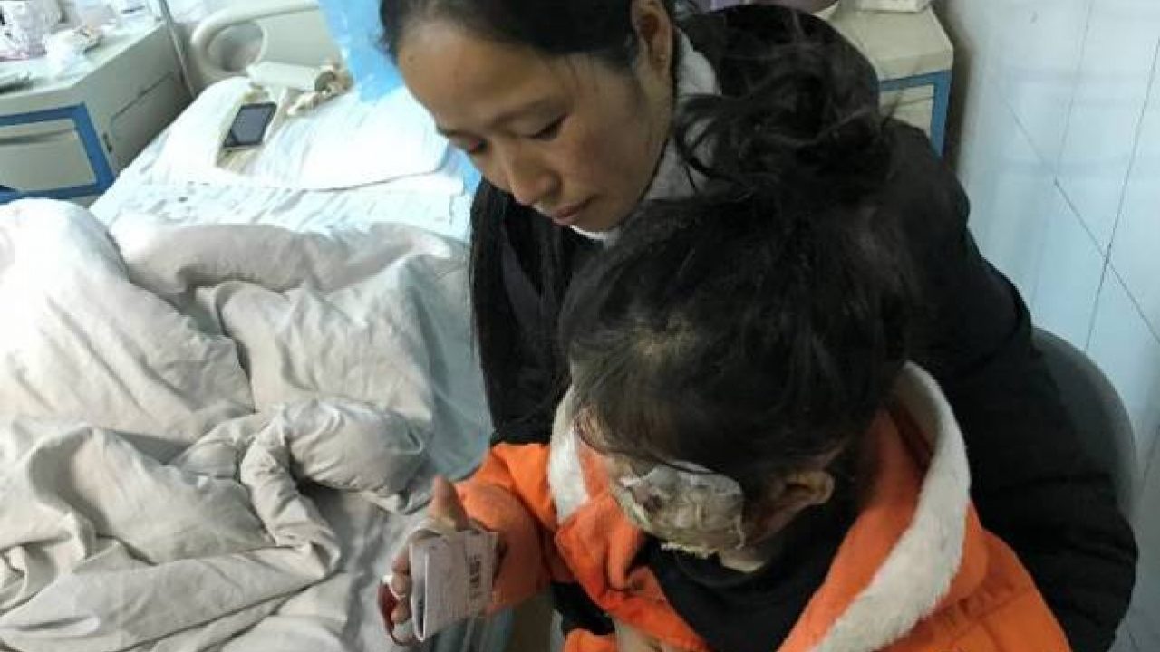 Felrobbanó Samsung telefontól égett meg egy 5 éves kislány 1