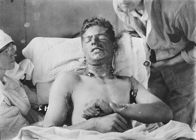 Mustárgáztól sérült katona. Fotó: wikipédia