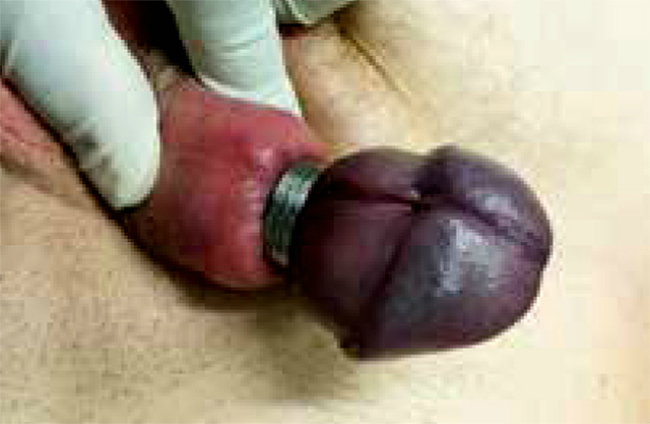 idegen tárgyak a péniszben erekció férfi fotó