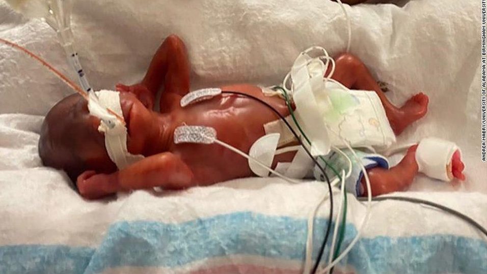 Világrekord: 420 grammal, öt hónapra született, de túlélte